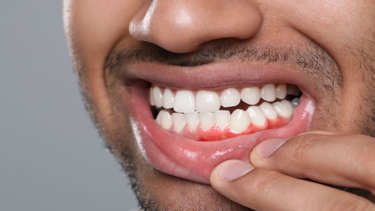 Gum Disease and Inflammation: What’s Happening Beneath the Surface